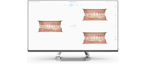 歯科用口腔内スキャナー