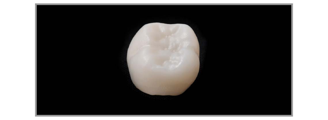 セラミックインレー