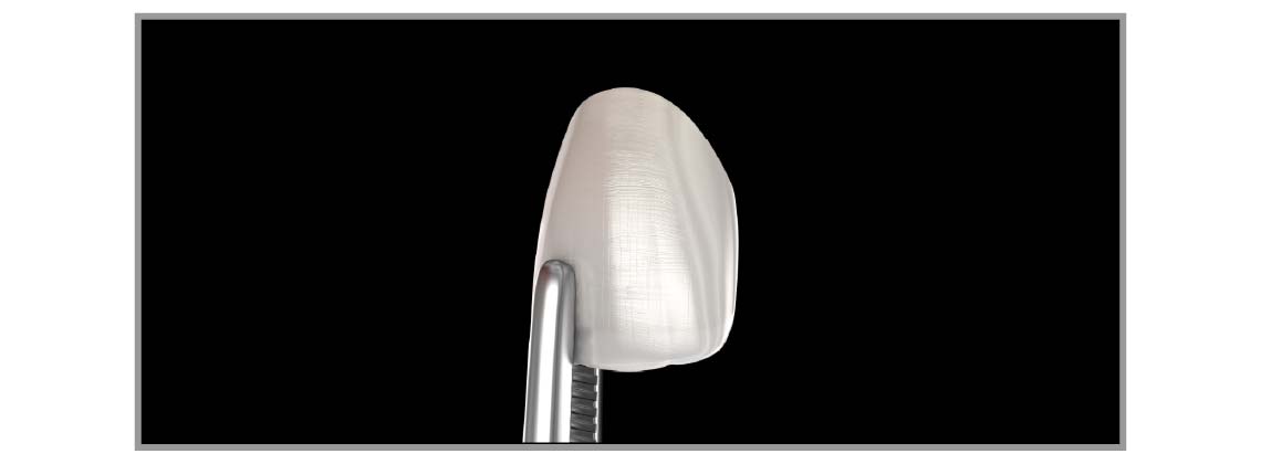 ラミネートベニア